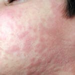 Measles